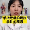 手指脱皮是什么原因引起的